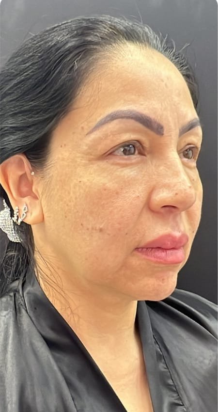 Antes del protocolo TotalFace